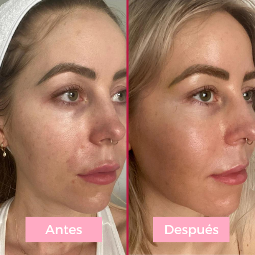 Lifting facial 5 en 1