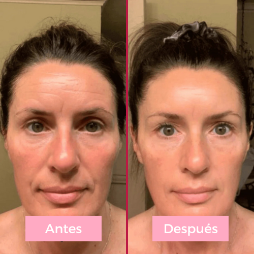 Lifting facial 5 en 1