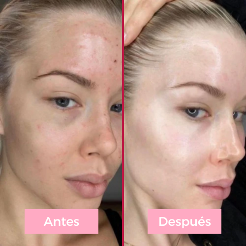 Lifting facial 5 en 1